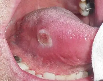 Oral Cavity Care